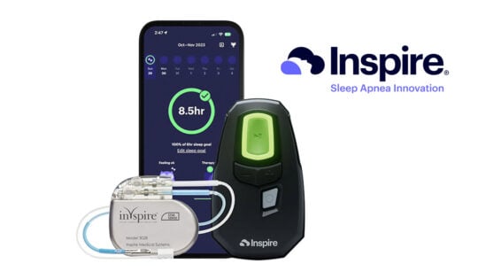 Inspire Sleep System by Inspire Medical