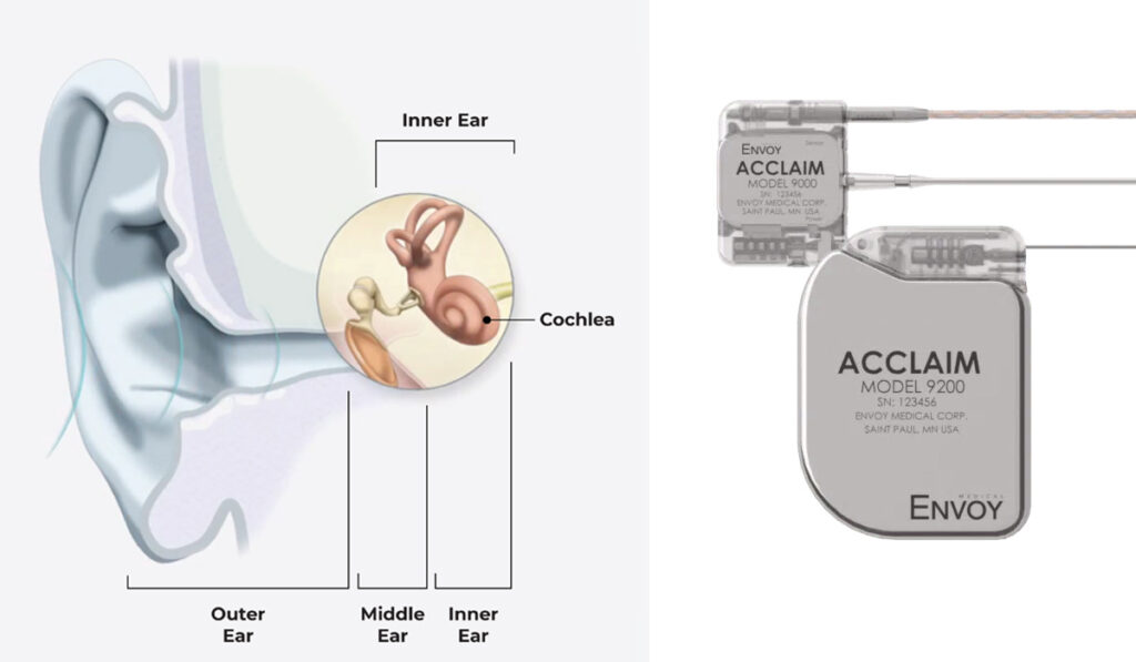 Diagram of the ear highlighting the cochlea alongside Envoy Medical&rsquo;s Acclaim fully implanted cochlear device, designed for hearing restoration in the inner ear.